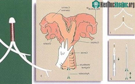 Thiết bị tránh thai cho bò. (Ảnh: pergaminovirtual)