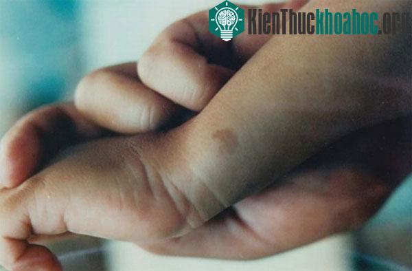 Vết bớt trên tay câu bé K. H. trùng vị trí với nơi người ta dùng muội than đánh dấu lên thi thể người ông. (Ảnh: Scientific Exploration)