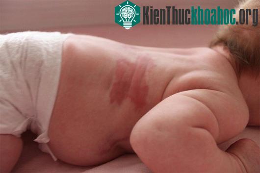 Nhiều người cho rằng, vết bớt là dấu vết của sự luân hồi