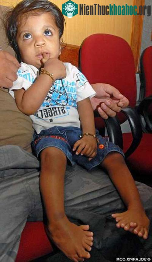 Mỗi bàn chân của Akshat Saxena đều có 10 ngón