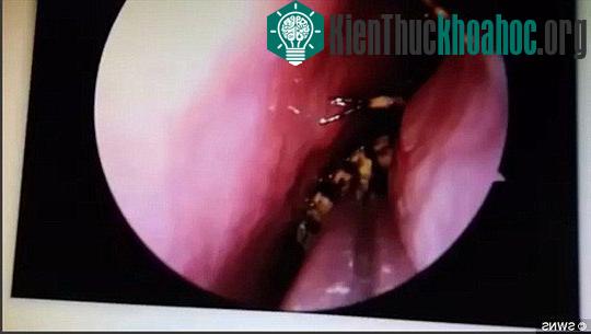 Hình ảnh ghi lại từ cuộc phẫu thuật loại bỏ con gián trong đầu bà Selvi. (Ảnh: SWNS).