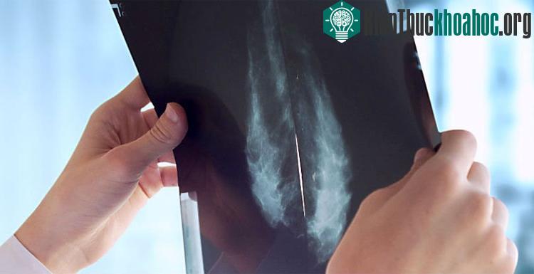 Phụ nữ có gene BRCA1 và BRCA2 bị đột biến sẽ dễ mắc bệnh ung thư vú. (Ảnh: Guschenkova/Shutterstock.com).