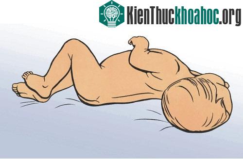 Trường hợp mắc hội chứng màng não điển hình sẽ thấy bệnh nhân nằm "tư thế cò súng".