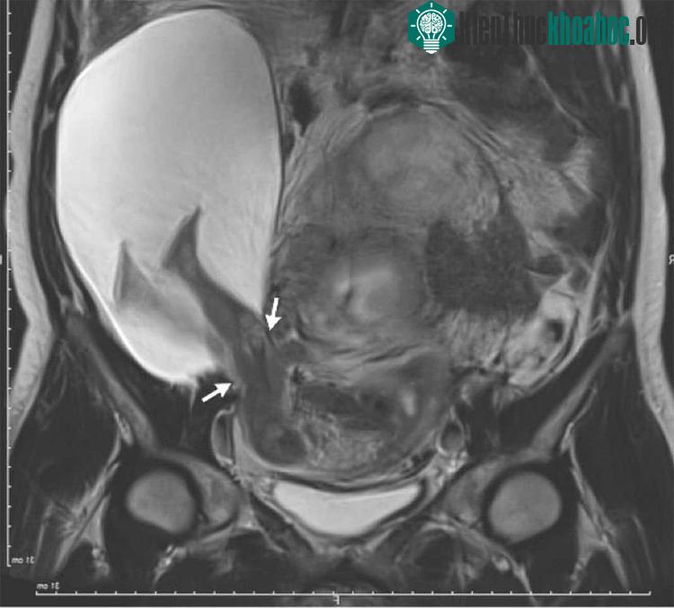 Các bác sĩ tin rằng, 5 lần mổ đẻ trước đó của người mẹ đã khiến thành tử cung bị yếu nghiêm trọng. (Nguồn ảnh: Thời báo y học New England).