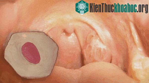 Nhiều người trong chúng ta có sỏi amidan mà không hề hay biết