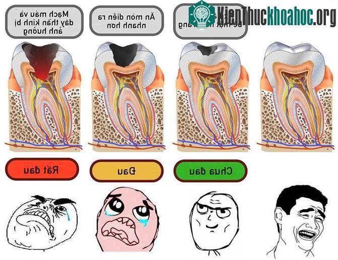 Về cơ bản, sâu răng là sự suy giảm dần dần sức khỏe răng miệng.