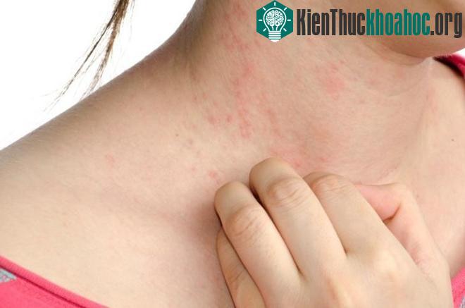 Bệnh gặp ở mọi lứa tuổi và hay tái phát.