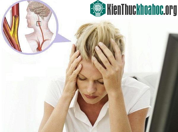 Đau đầu là triệu chứng rối loạn hoạt động não bộ, tăng nguy cơ đột quỵ.