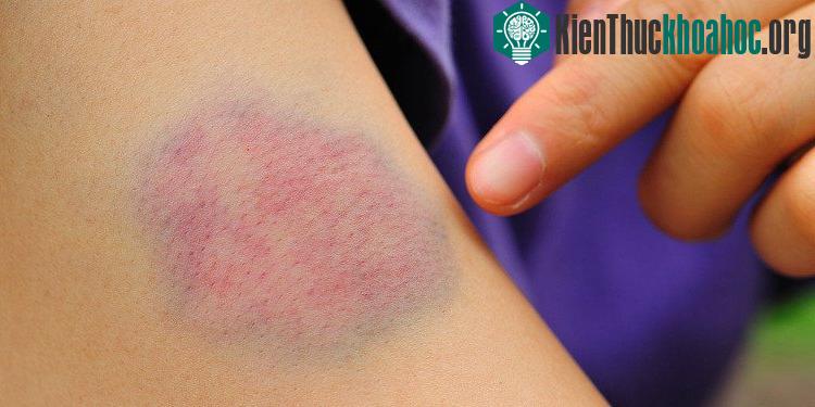 Xuất hiện bầm máu dưới da là một trong những triệu trứng sớm của bệnh ung thư máu.