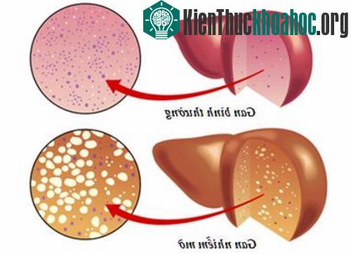 So sánh gan khỏe và gan nhiễm mỡ.
