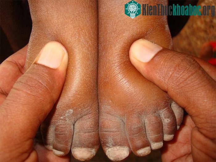 Da chân bị lõm khi dùng tay ấn xuống