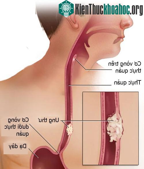 Ung thư thực quản dễ nhầm lẫn với các với các bệnh lý khác ở thực quản và vùng hầu họng.