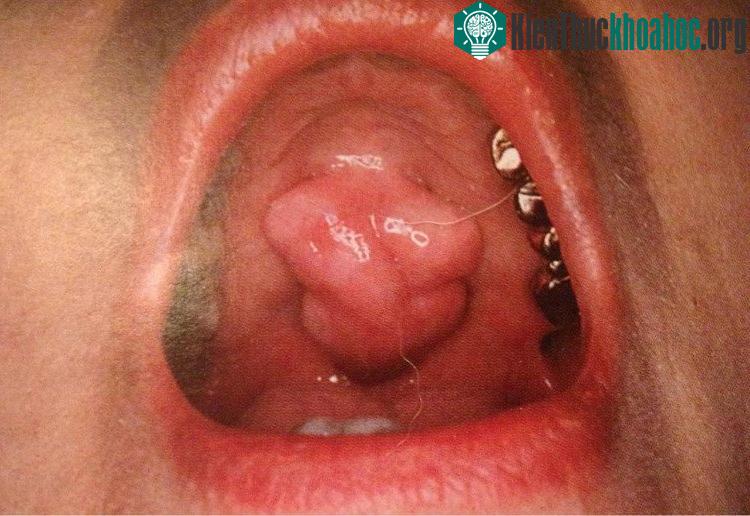 Một trường hợp u lồi khẩu cái cứng. (Ảnh: denturaid).