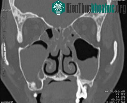 CT scan mũi xoang.