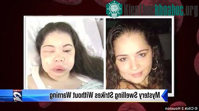 Linda Miller là một bệnh nhân phù mạch di truyền tới từ Houston, Texas.