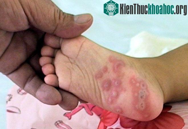 Biểu hiện nốt phỏng ở lòng bàn chân trong bệnh tay chân miệng. (Ảnh: Sức khỏe đời sống)