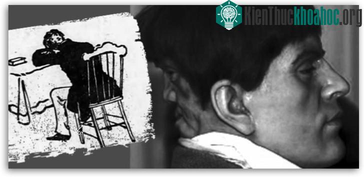 Hình ảnh được cho là của Edward Mordake kèm tranh minh họa trong cuốn Anomalies and Curiosities of Medicine. (Ảnh: Hoaxes).