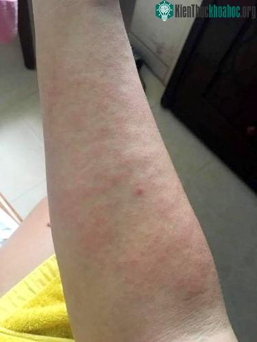 Bệnh nhân nổi mề đay khắp cánh tay do tiếp xúc với nước bẩn. (Ảnh: NP).