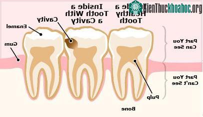 Cách duy nhất để sửa chữa những thiệt hại này chính là đi trám răng.