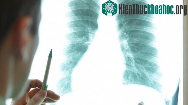 Bệnh nhân ung thư sống sót sau 5 năm phát hiện bệnh thì có thể coi là khỏi bệnh hoàn toàn.