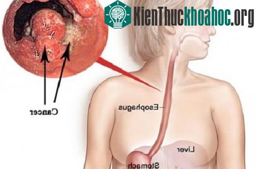 Điều trị ung thư bằng virus đang được giới y học đặc biệt chú ý.