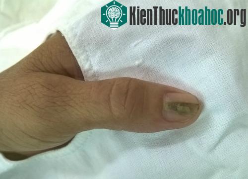 Biểu hiện của u cuộn mạch dưới móng là móng tay có sọc, đau nhức kéo dài. (Ảnh: X.A).