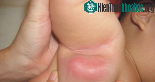 Ung thư da là một căn bệnh vô cùng nguy hiểm