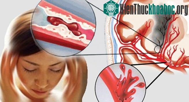 Khi mạch máu bị tắc nặng, có thể xuất hiện các tình trạng kỳ lạ khác nhau – hoặc các cơn đau không liên tục.