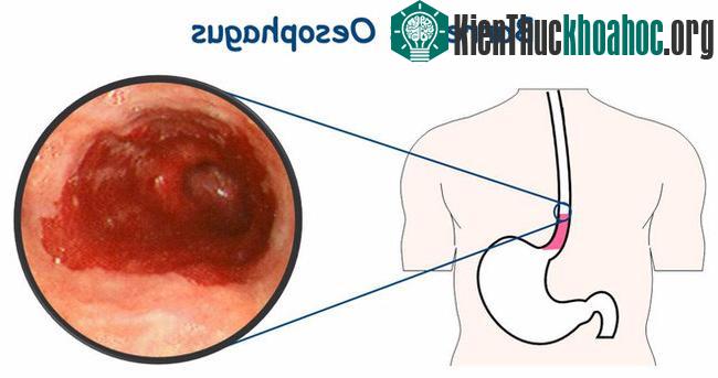 Có hơn 500.000 người thiệt mạng trên thế giới mỗi năm do ung thư thực quản.