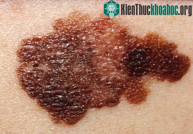 Ung thư tế bào hắc tố da là căn bệnh rất phổ biến