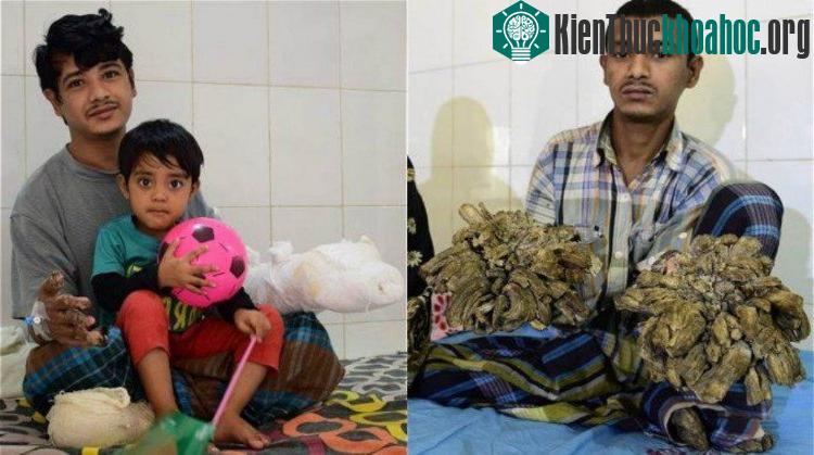 Abul trước và sau phẫu thuật. (Ảnh: AFP).