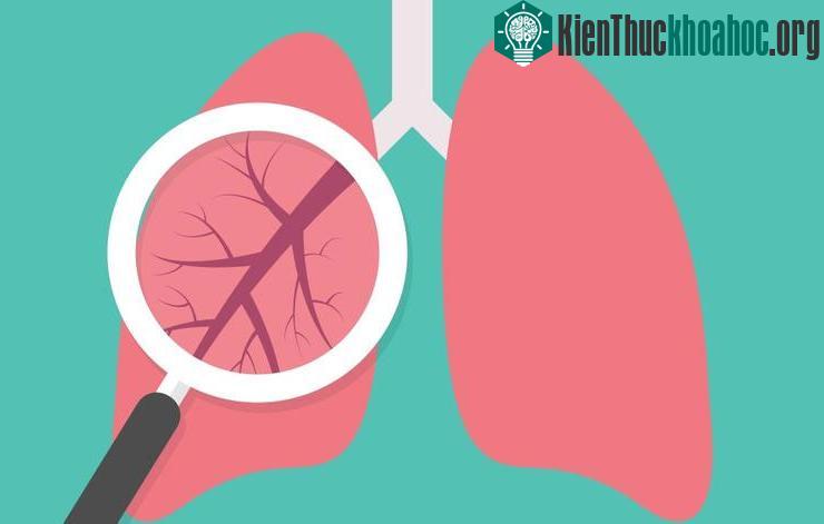 Những bệnh nhân mắc căn bệnh này có đến 28% là những người chưa bao giờ chạm tay vào một điếu thuốc.