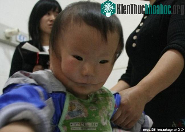 Đây là dị tật cực hiếm và rất nghiêm trọng.