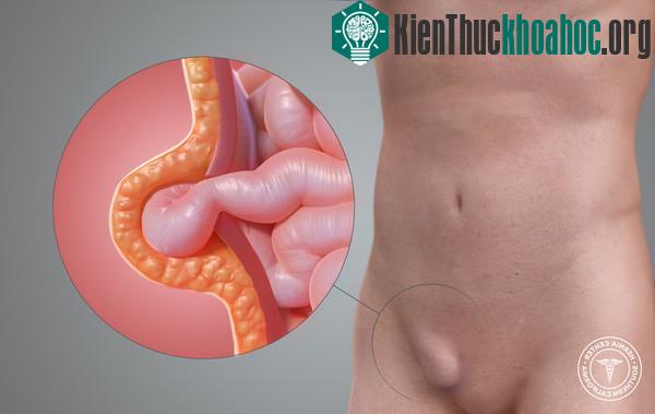 Thoát vị bẹn - ruột sa qua ống bẹn, thường gặp nhất ở nam giới.