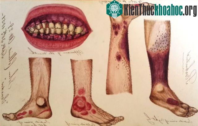 Các biểu hiện của căn bệnh đã dày vò các thủy thủ.