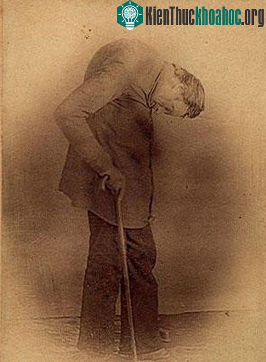 Trask với phần lưng cong gập và cằm chạm ngực. (Ảnh: Showhistory).