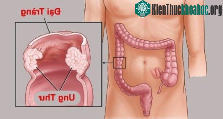 Bệnh ung thư trực tràng cũng rất dễ xảy ra ở lứa tuổi 20.