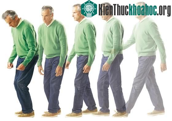 Bệnh Parkinson thường gặp ở người lớn tuổi, chỉ 10% trường hợp khởi phát tuổi dưới 40.