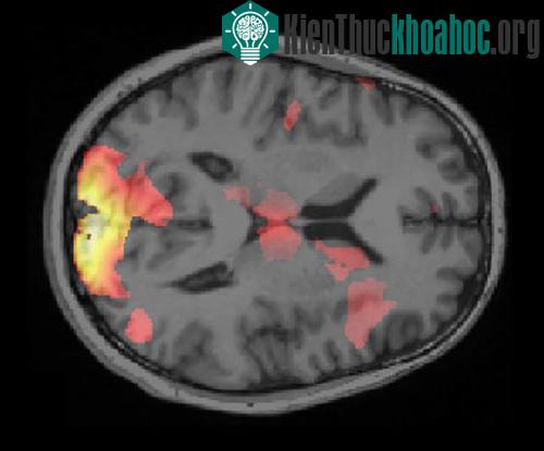 Ảnh chụp não có đánh dấu trí tuệ nhân tạo. (Ảnh: Ai Koizuzmi).