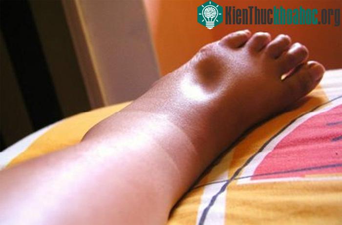 Chân phù dấu hiệu của bệnh tim mạch