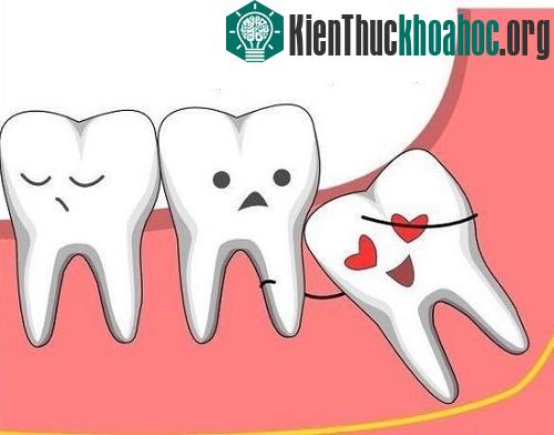 Không phải tất cả những chiếc răng khôn nào cũng cần phải loại bỏ.