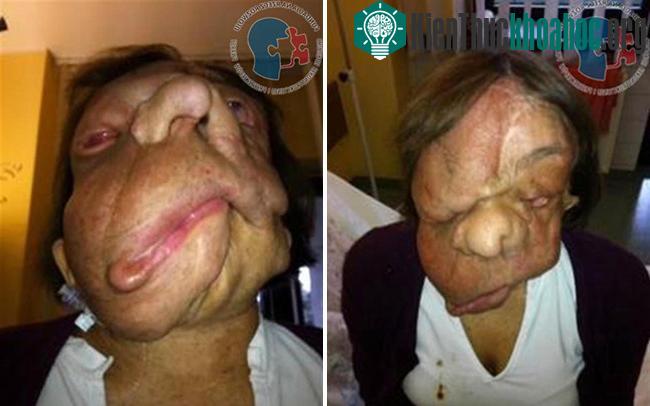 Khối u chèn lên mặt khiến Joanna không thể cử động được miệng.