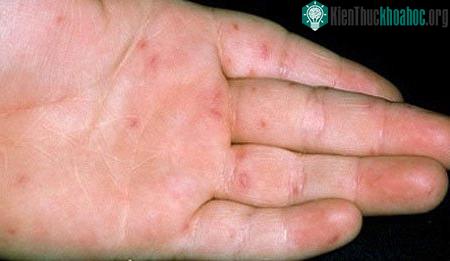 Không được làm vỡ những nốt này, vì có thể khiến bệnh lây lan