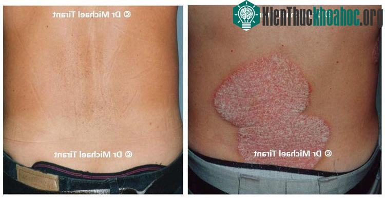 Những điều bạn cần biết về corticoid điều trị bệnh vảy nến ảnh 1