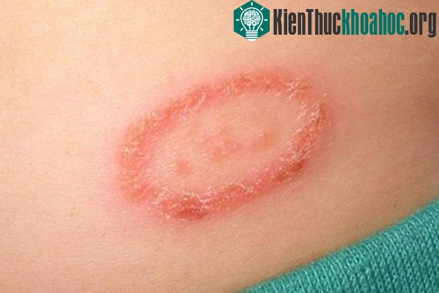 Viêm da tiếp xúc khi bị dính chất độc của kiến ba khoang. (Ảnh minh họa).