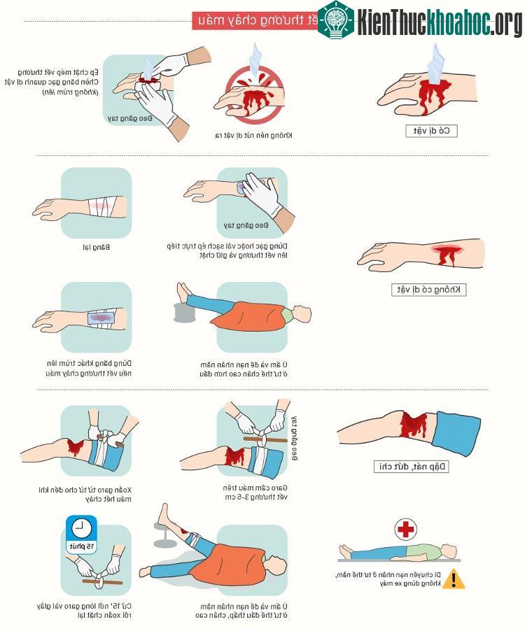 Đối với vết thương hở không có dị vật, bạn dùng gạc hoặc vải sạch ép trực tiếp lên vết thương và giữ chặt.