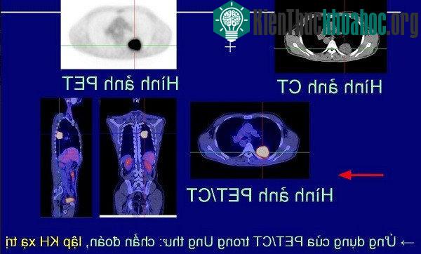 Ứng dụng của PET/CT trong điều trị ung thư
