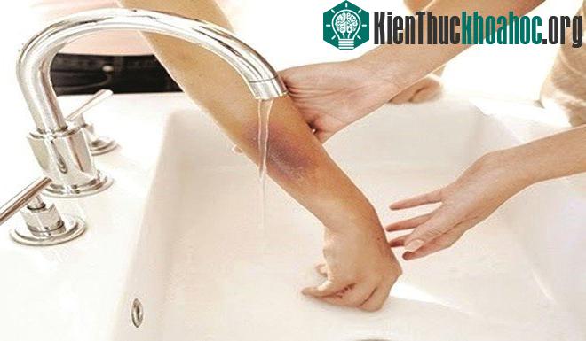 Ngoài tìm hiểu cách sơ cứu cơ bản, bạn nên mua thêm các loại thuốc trị bỏng đề phòng.