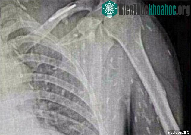 Sán có thể tồn tại trong cơ thể người nhiều tuần hoặc nhiều tháng mà không bị phát hiện.