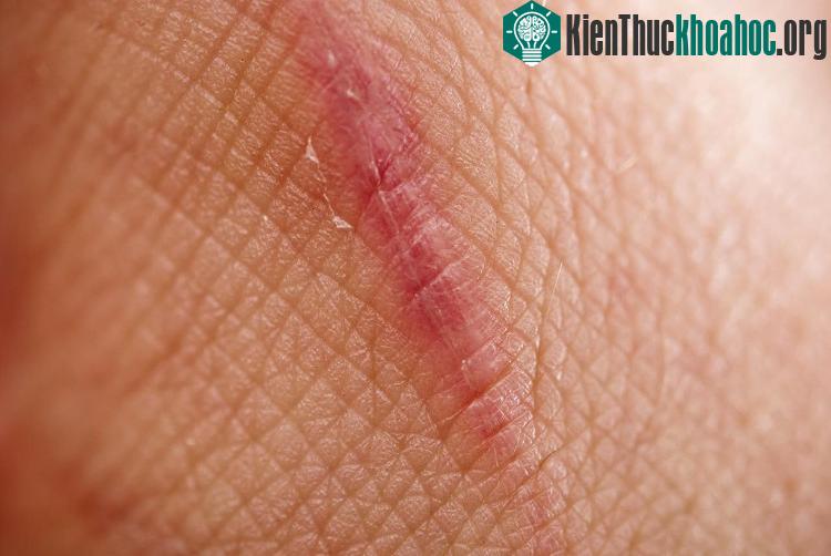 Nếu dùng protein này trong quá trình phục hồi vết thương, da có thể liền lại mà chẳng hề có sẹo.